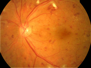 Damaged retina