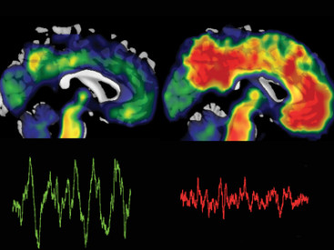 Heavy deposits of the toxic protein, beta-amyloid, shown in red may be paving the way for Alzheimer's disease (Photo courtesy of Bryce Mander and Matthew Walker)