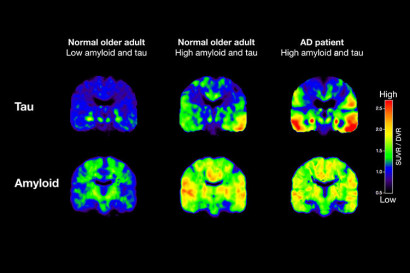 Shown are PET scans that track tau (top row) and beta-amyloid from two normal older people and a patient with Alzheimer’s disease (AD). The normal older adult on the left has no brain amyloid deposition and minimal tau in the medial temporal lobe. In the normal older adult in the middle, amyloid deposition is present throughout the brain, and tau has spread out into the temporal cortex. In the AD patient, both amyloid and tau are spread through the brain. (Image by Michael Schöll)