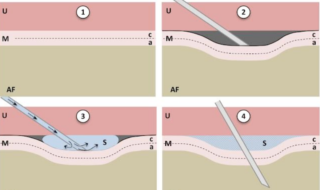 Fetal surgery with fewer complications may result from pre-sealing, which involves using a needle to make a tented space between the uterine wall and fetal membrane without puncturing the membrane: 1. Before intervention (uterus, U; membranes, M; amniotic fluid, AF; amnion, a; chorion, c). 2. “tenting” of membranes using oblique needle insertion. 3. Injection of liquid sealant (s) between amnion and uterine wall. 4. Intervention through pre-sealed membranes. 