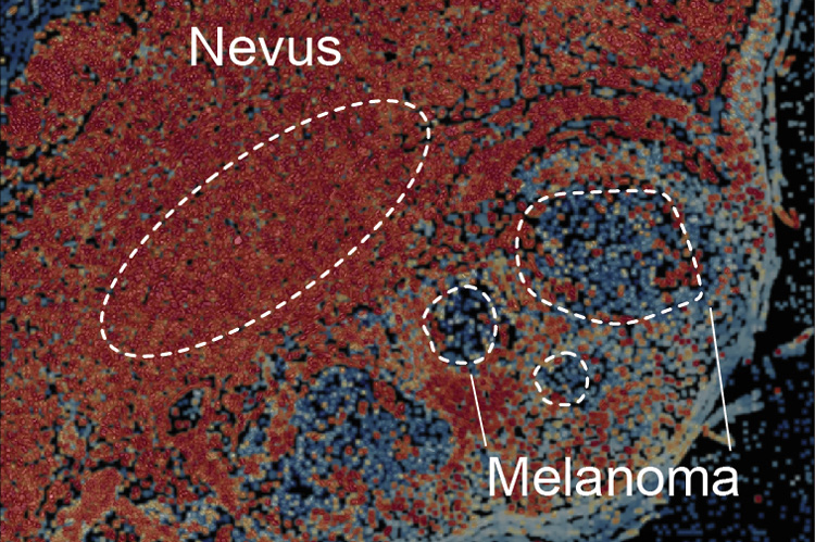 a benign nevus transitioning to a malignant melanoma