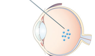 schematic of eyeball showing injection of viruses