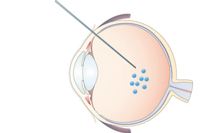 schematic of eyeball showing injection of viruses