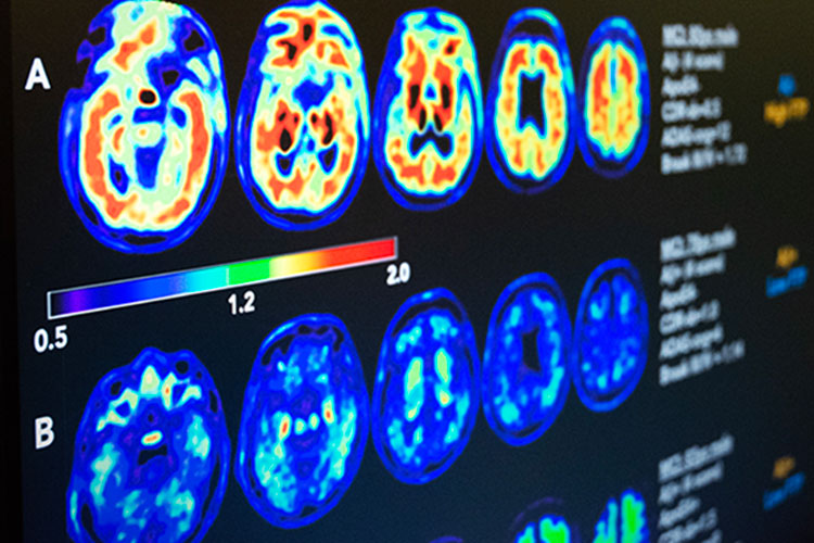 A close up of a computer screen that shows positron emission tomography scans