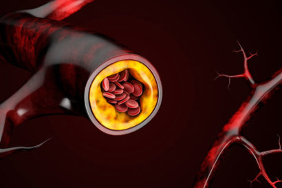 3-D illustration of blood vessels with plaque buildup.