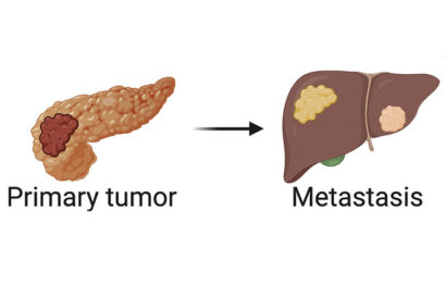 a tumor on the pancreas on left, tumors on the liver on right