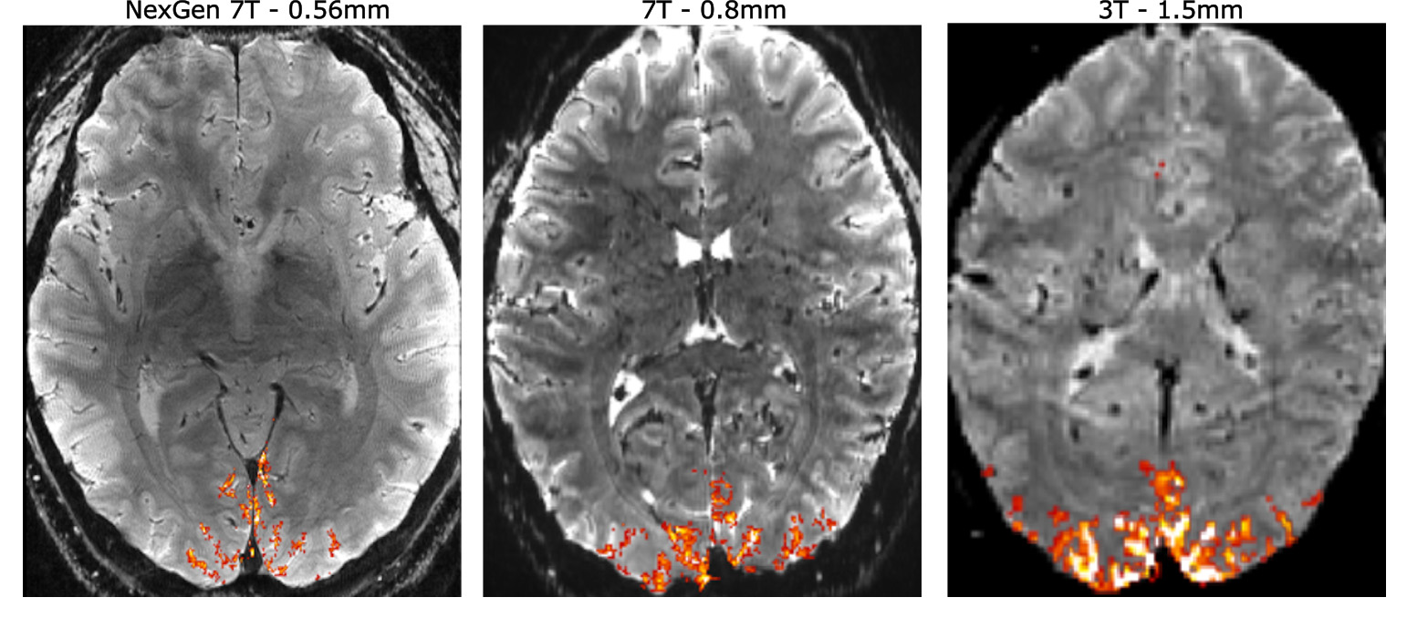 3 gray and white slices through the brain with a few areas highlighted in orange and yellow