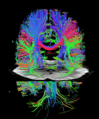 diffusion MRI showing major nerve cell axons