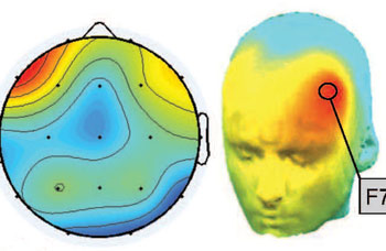 sleep spindle in left temporal lobe