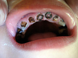 Child's teeth, rotted to the gum