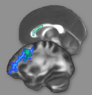 The green and blue areas indicate regions of white matter that changed as a result of intense reasoning training.